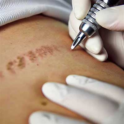 Medische tatoeage behandelingen in Maasmechelen